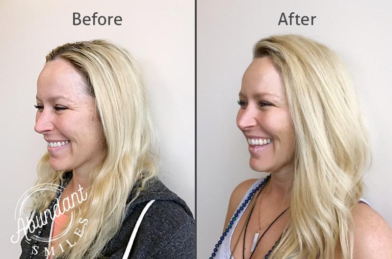 A before and after photo of a patient after botox treatment