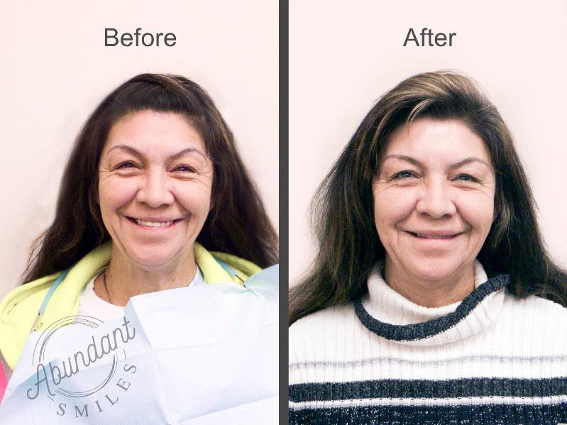 A before and after photo of a patient's botox treatment
