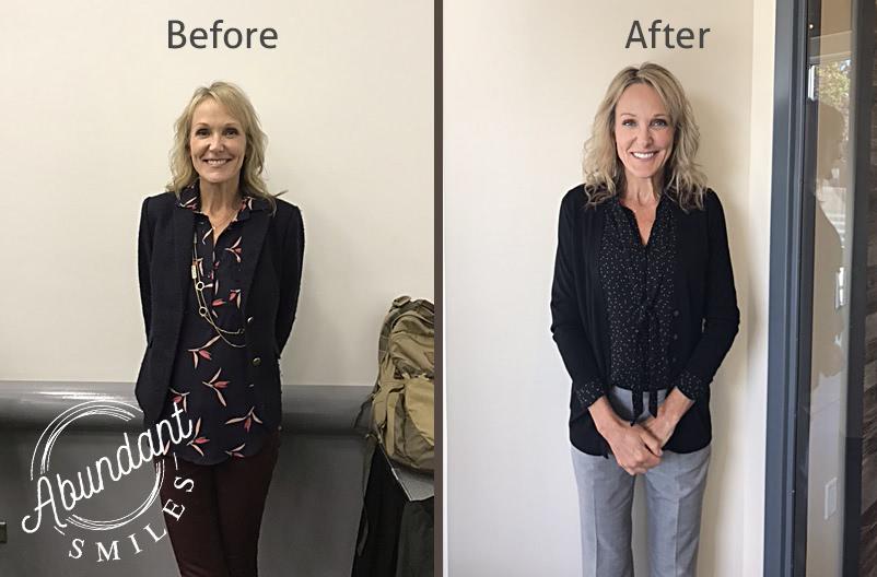 a before and after photo of a standing patient after botox treatment