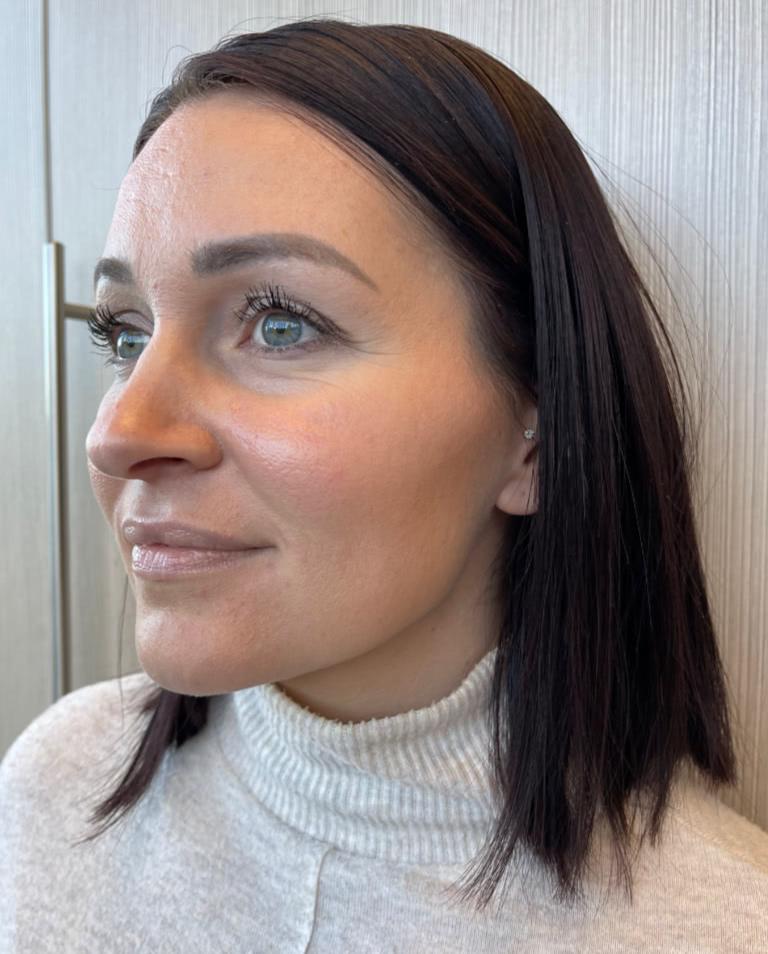 Three quarter view of a woman in a white sweater after botox treatment