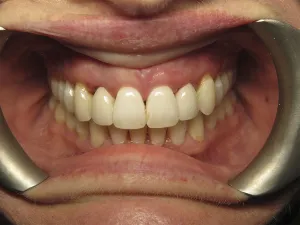 case 600 retracted after photo
