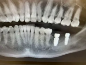 An after photo of an x-ray