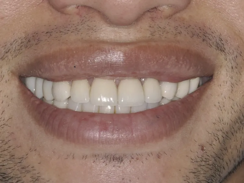 case 0100 smile after photo