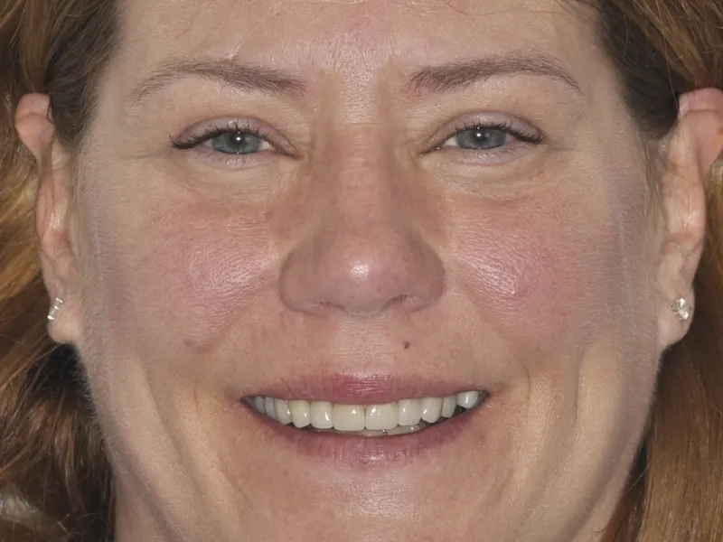 case 0106 full face after photo