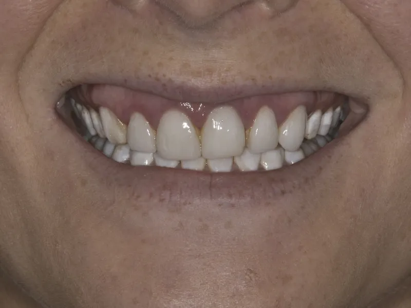  Case 0109 Smile Before photo