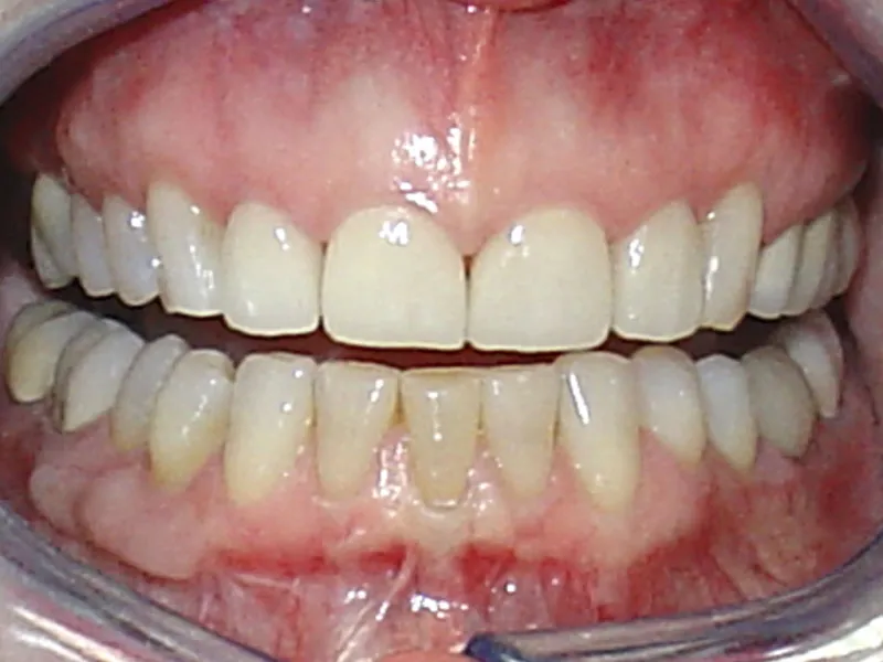 case 012 retracted after photo 