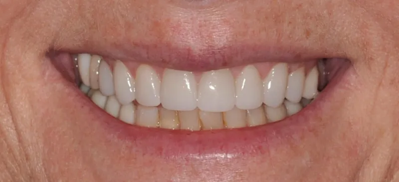 An after photo of a woman smiling with a healthy smile