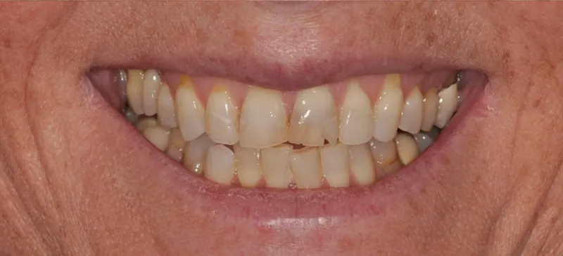 A before photo of a woman smiling with a healthy smile