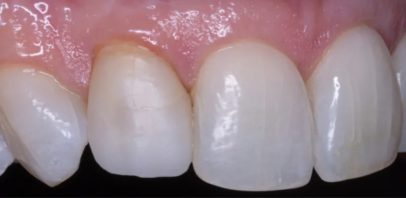 A row of top teeth with slight cracks