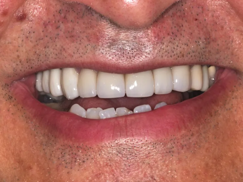 case 023 smile after photo