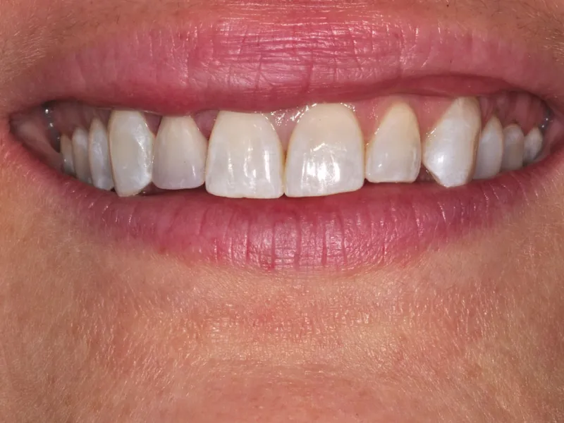 case 025 smile after photo