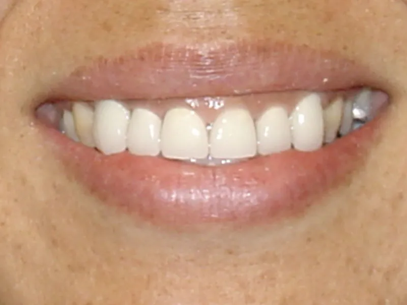 case 026 smile after photo