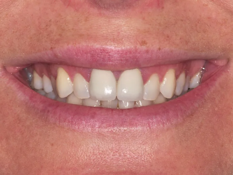 case 031 smile after photo
