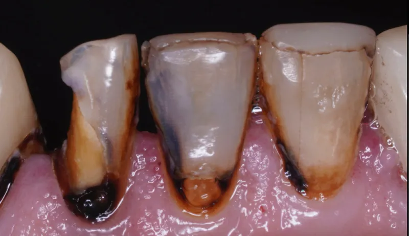 After closeup of teeth crowns