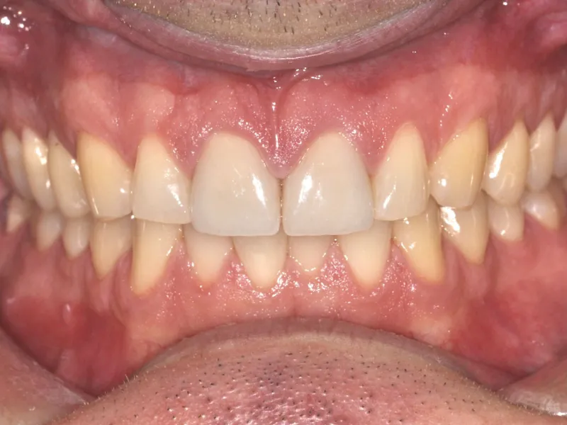 case 032 retracted after photo