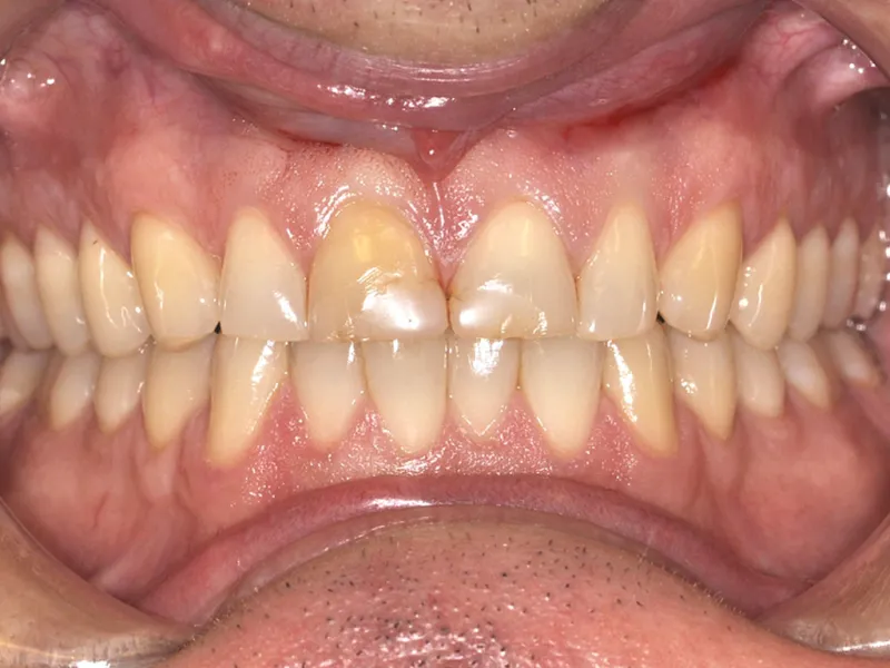 case 032 retracted before photo