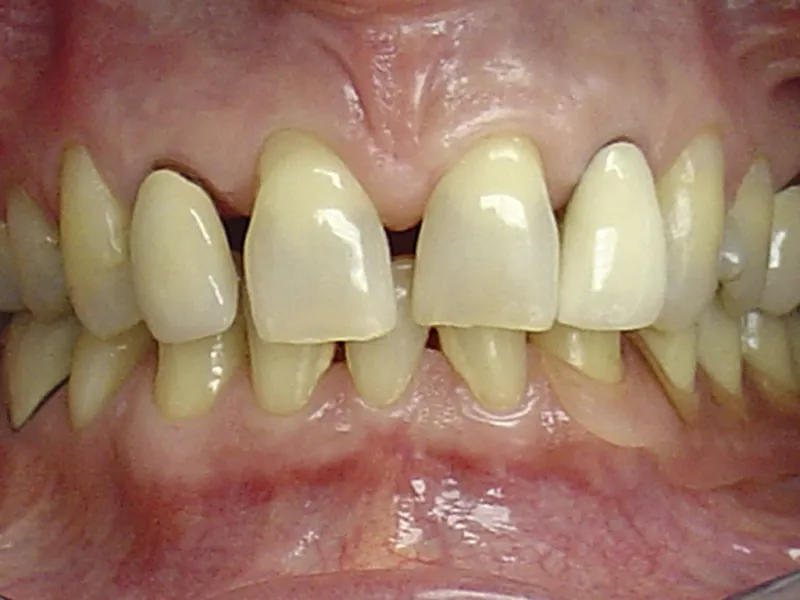 case 038 retracted before photo