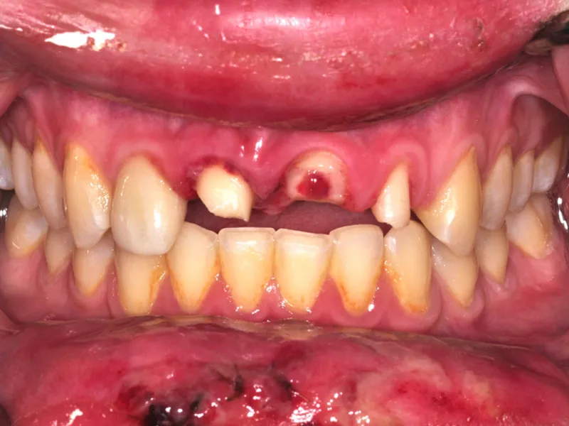 case 039 retracted before photo