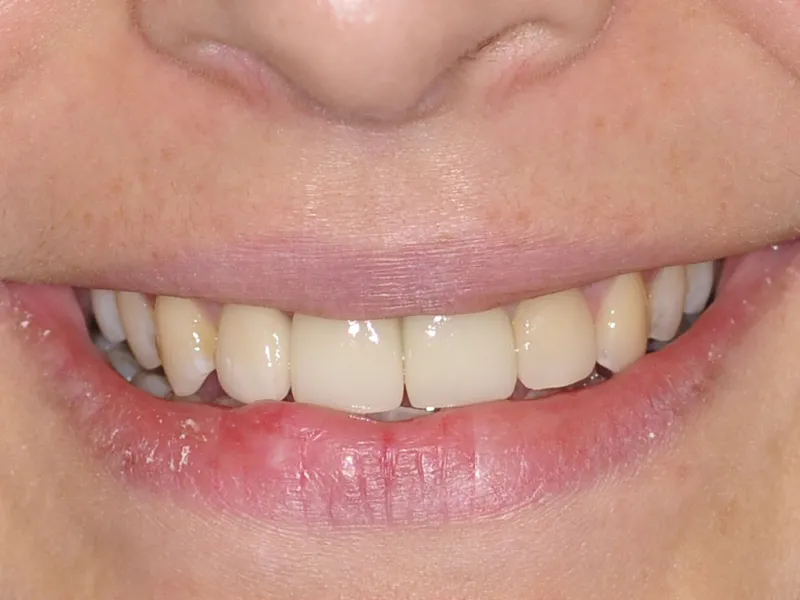 case 039 smile after photo