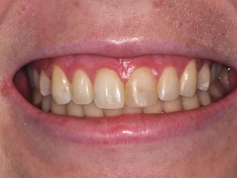 case 040 smile before photo