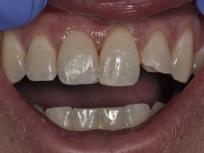 case 041 smile before photo