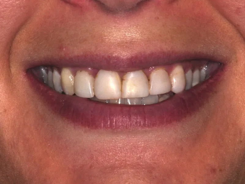 case 052 smile before photo