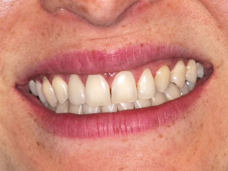case 053 smile after photo