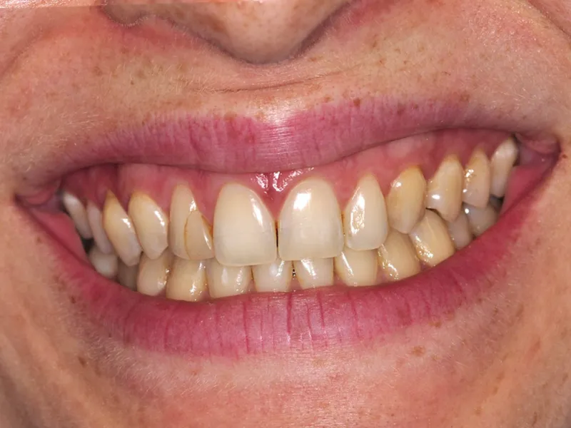 case 053 smile before photo