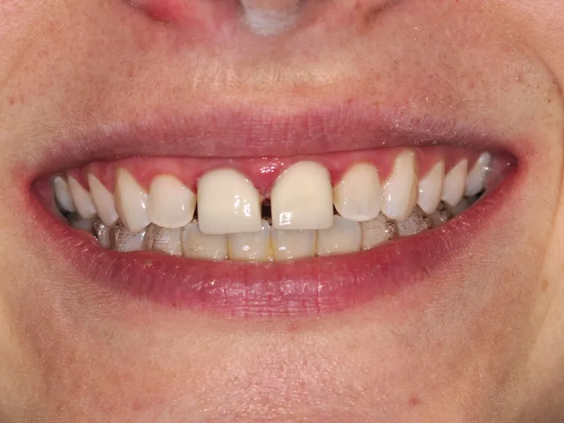 case 054 smile before photo