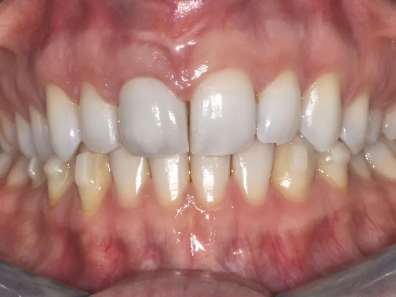 case 055 retracted after photo