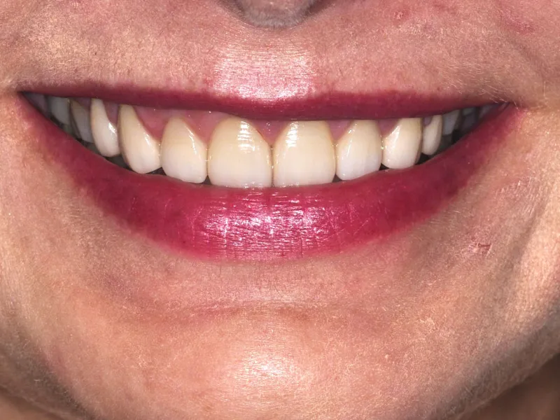 case 056 smile after photo