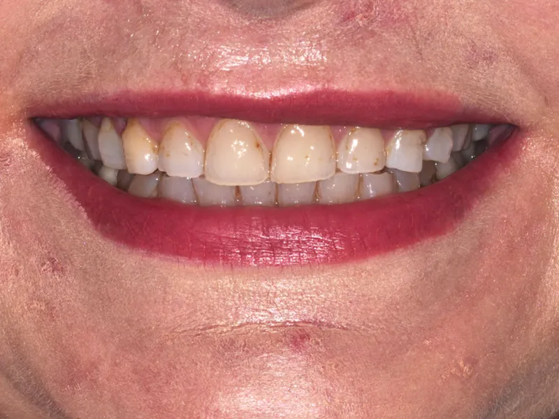 case 056 smile before photo