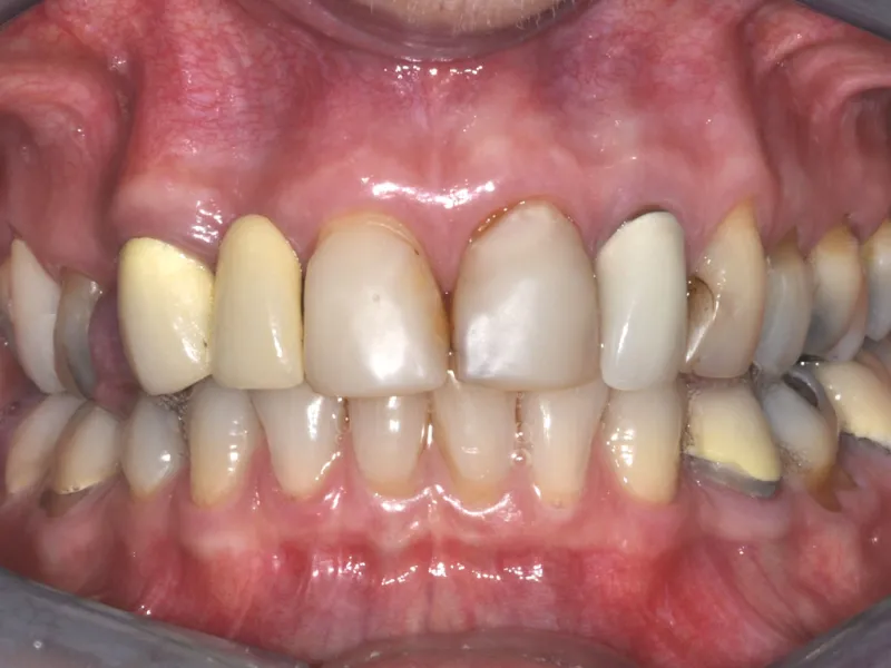 case 058 retracted before photo