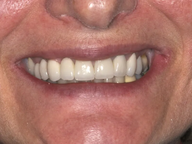 Case 058 smile after photo