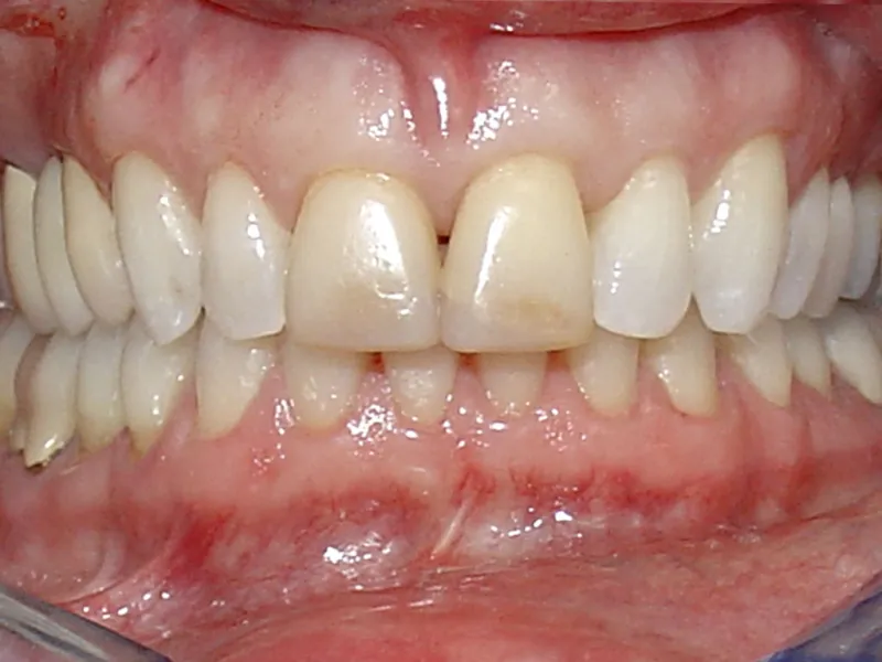 case 060 retracted before