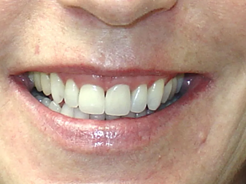 case 060 smile after photo