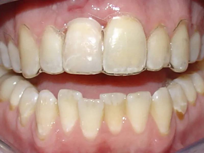case 061 retracted after photo