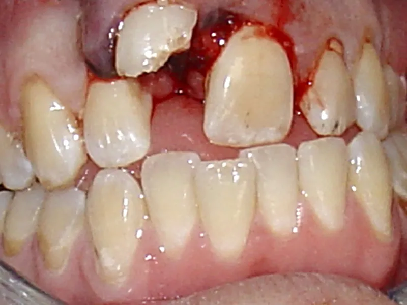 case 061 retracted before photo