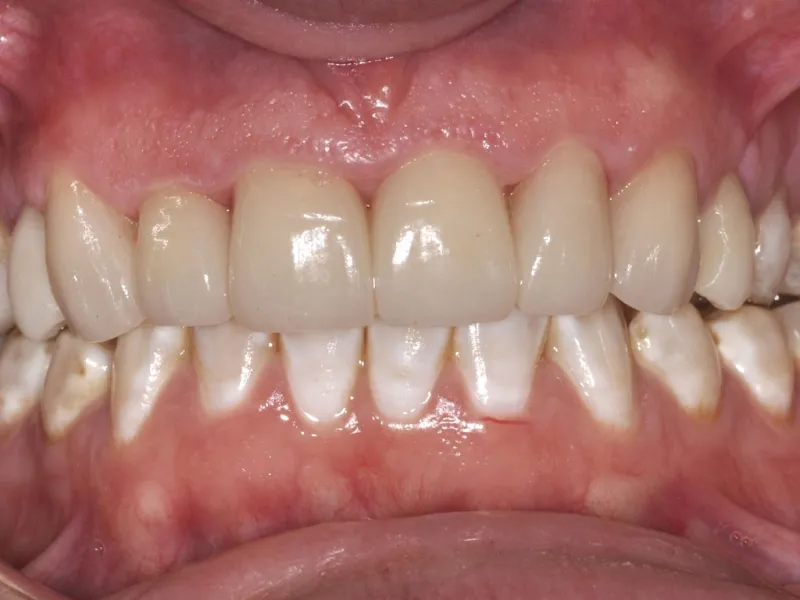 case 062 retracted after photo