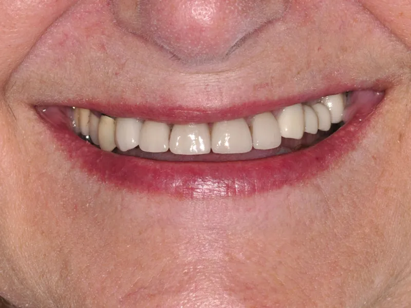 case 064 smile after photo