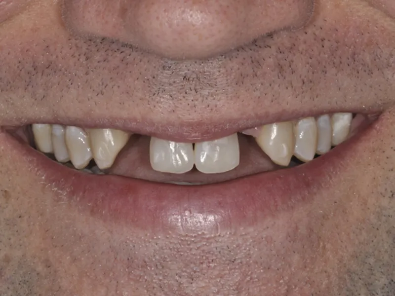 case 085 smile before photo
