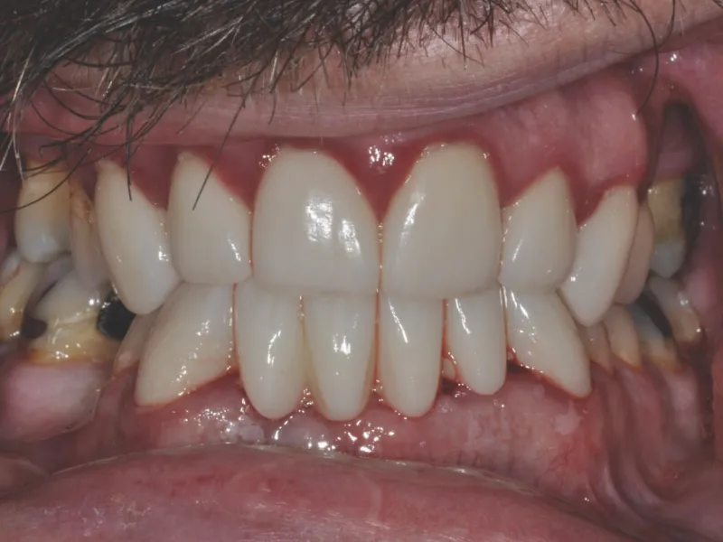 Case 304 Retracted After photo
