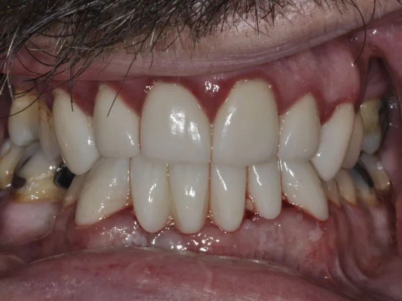 case 304 retracted after photo