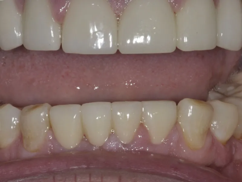 case 306 retracted after photo