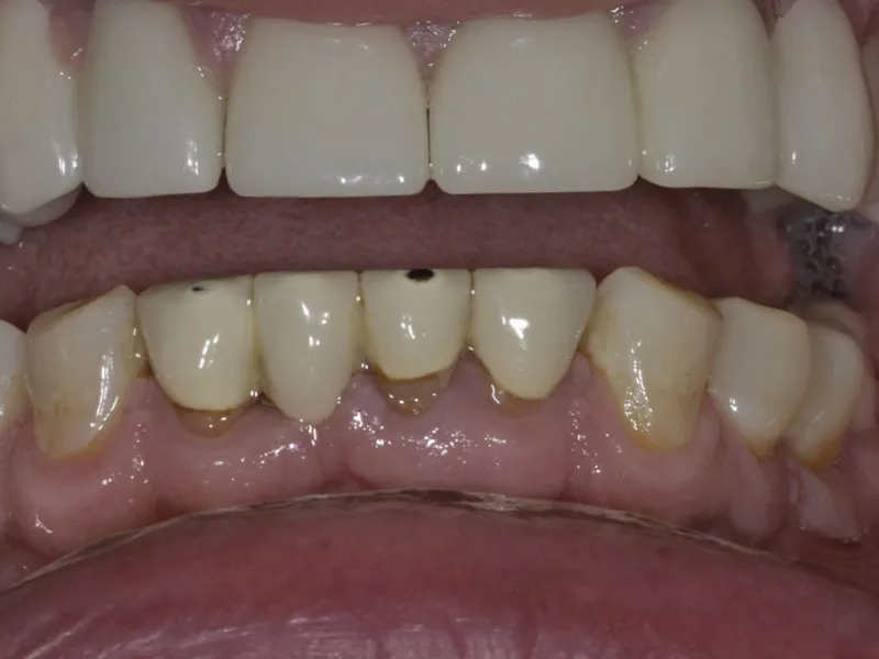 case 306 retracted before photo