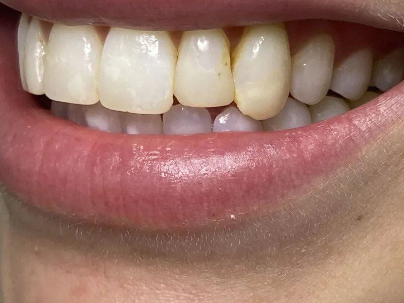 Case 502 Smile Before photo