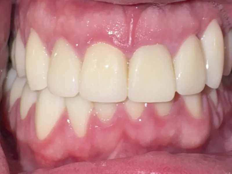 Case 504 Retracted After
