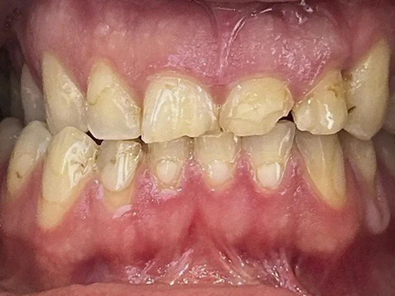 Case 504 Retracted Before photo