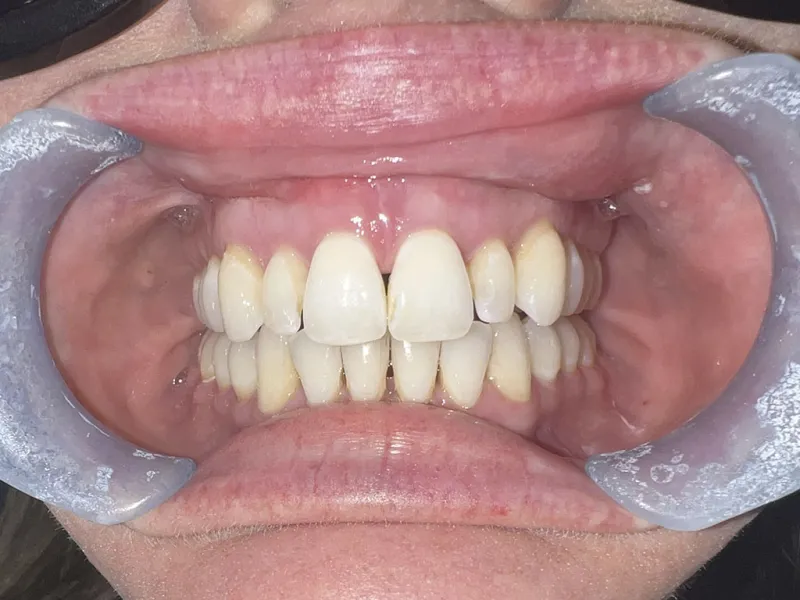 Case 600 Retracted Before photo