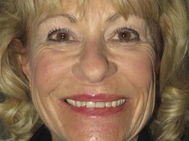 picture of case 602 full face before